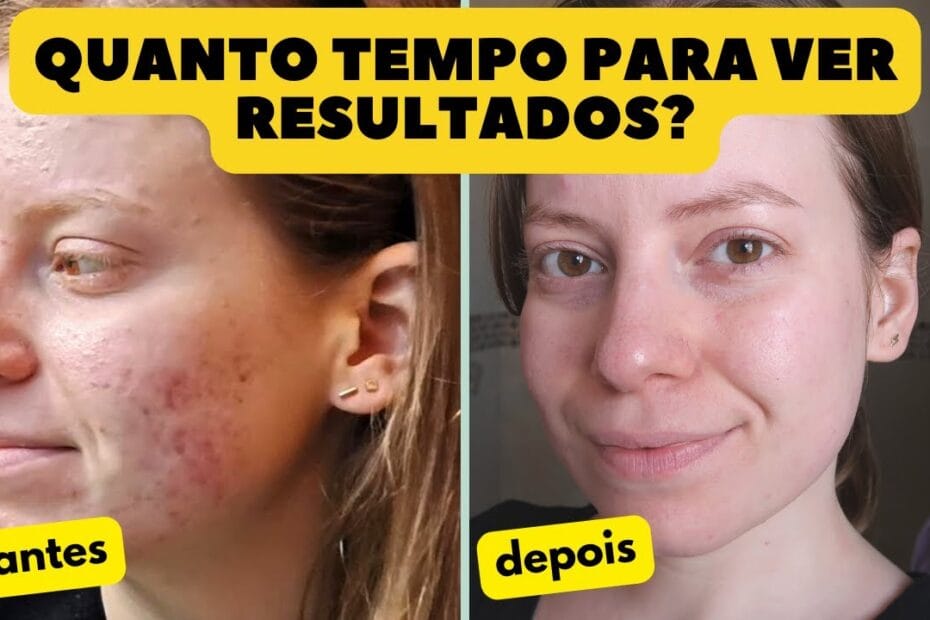 acnzel vs visara antes e depois